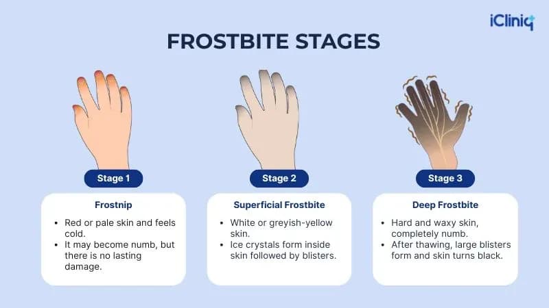 What Is Frostbite?